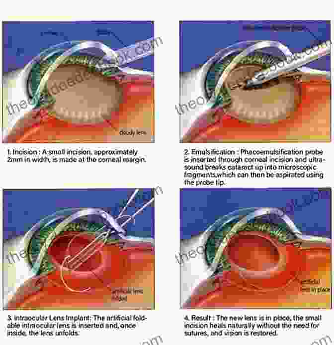 Cataract Surgery Procedure Ophthalmic Surgical Procedures Peter S Hersh