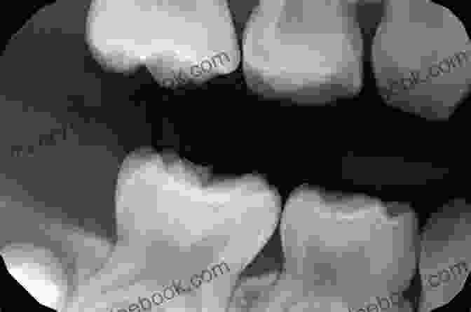 Dental Radiography Image Showing Cavities Between The Teeth. Oral Diagnosis: Minimally Invasive Imaging Approaches