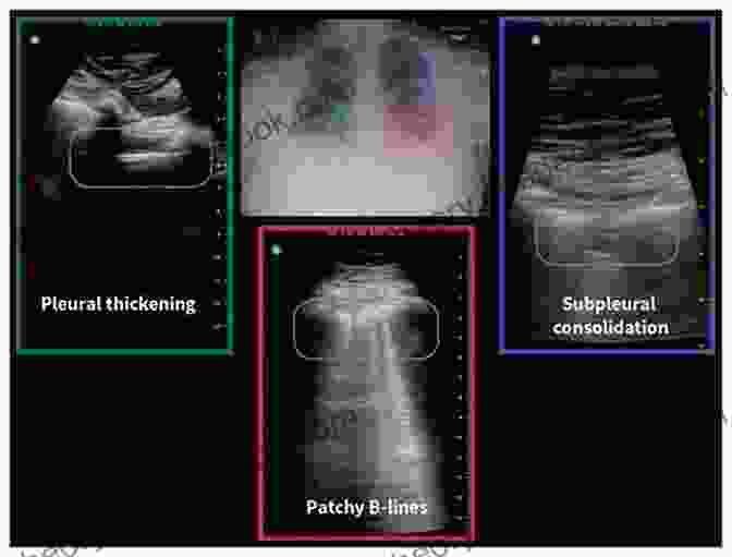 Lung Ultrasound Image Ultrasonography In The ICU: Practical Applications