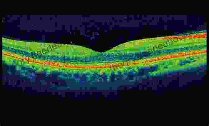 Optical Coherence Tomography (OCT) Image Revealing Structural Changes In The Retinal Layers In Uveitis. Atlas Of Uveitis: Diagnosis And Treatment