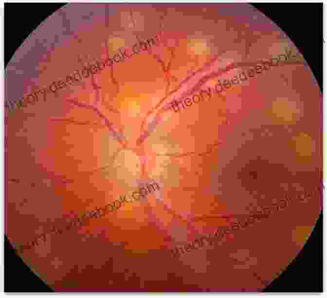 Posterior Pole Inflammation In Posterior Uveitis, Showing Choroidal Infiltration And Retinal Edema. Atlas Of Uveitis: Diagnosis And Treatment